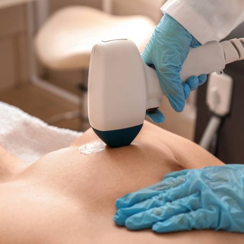 Epilazione laser per gli uomini perché proporla nel tuo salone