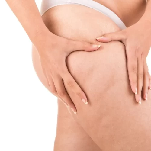 Cellulite e ritenzione idrica trattamenti estetici più efficaci nei centri professionali
